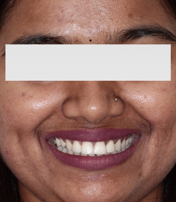 After: Diastema closure